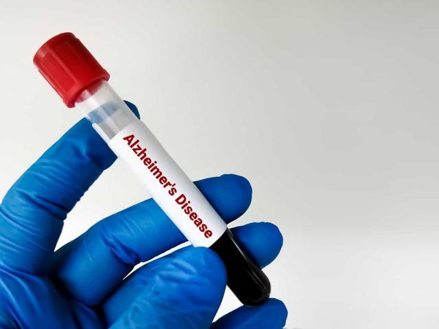 Novo teste de sangue pode prever Alzheimer até 20 anos antes dos sintomas